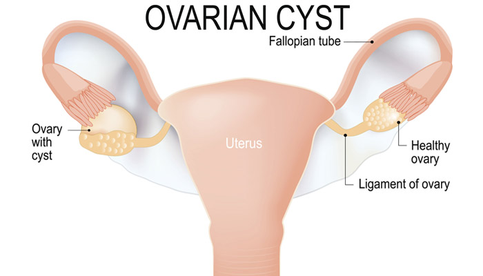 Ovarian Cysts